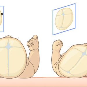 Approche clinique et traitement kinésithérapeutique des déformations crâniennes du nourrisson
