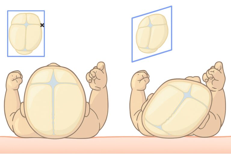 Approche clinique et traitement kinésithérapeutique des déformations crâniennes du nourrisson