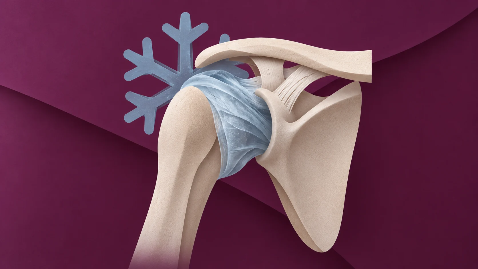 L’épaule raide : rééducation des capsulites, arthroses, GIRD et fractures