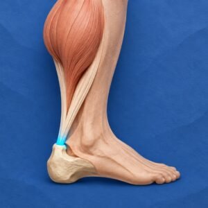 Tendinopathie d'Achille : mécanismes et impact chez le coureur